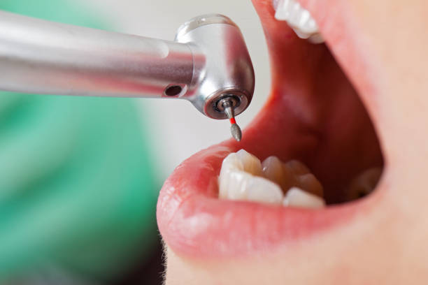 Best Dentist for Tooth Abscess  in Lampasas, TX
